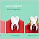 gum disease dentist bellevue wa