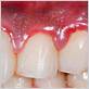 gum disease dentist bluffton