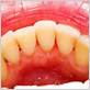 gum disease dentist burnsville