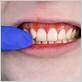 gum disease dentist madera california