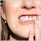 gum disease denver co