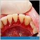 gum disease due to broken tooth