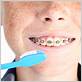 gum disease during braces