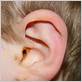 gum disease ear infection