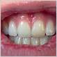 gum disease erysipelas