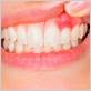 gum disease estraction