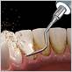 gum disease flower mound