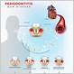gum disease fluid around heart