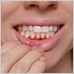 gum disease flushing ny