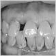 gum disease fort collins co