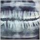 gum disease from braces x ray