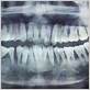 gum disease from braces xray