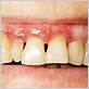 gum disease from crown