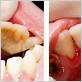 gum disease full debridement