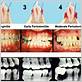 gum disease gaps in teeth