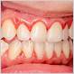 gum disease getting better itchy gums