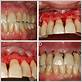 gum disease gingival flap surgery