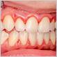 gum disease gingivitis hurst tx