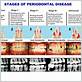 gum disease gingivitis stages