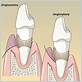 gum disease gingivoplasty