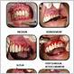 gum disease healing time