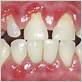 gum disease hiv