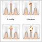 gum disease hormonal changes