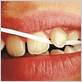 gum disease impotence
