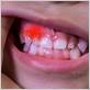 gum disease in children tomball tx