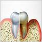 gum disease in frisco tx