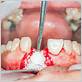 gum disease in lynnwood