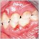 gum disease in pediatric