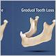 gum disease jaw bone loss
