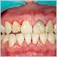 gum disease juul