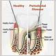 gum disease kennesaw