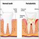 gum disease kirkland