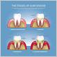 gum disease known as gingivitis