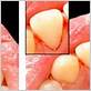 gum disease lakewood ranch fl