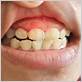 gum disease largo fl