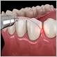 gum disease laser treatment cost uk