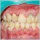 gum disease lead to cancer