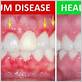 gum disease liverpool