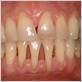 gum disease loose front tooth