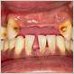 gum disease losing teeth