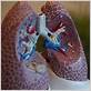 gum disease lungs