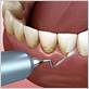 gum disease management