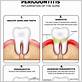 gum disease meaning french