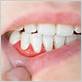 gum disease mesquite tx