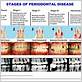 gum disease mild to severe chart