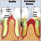 gum disease minneapolis mn